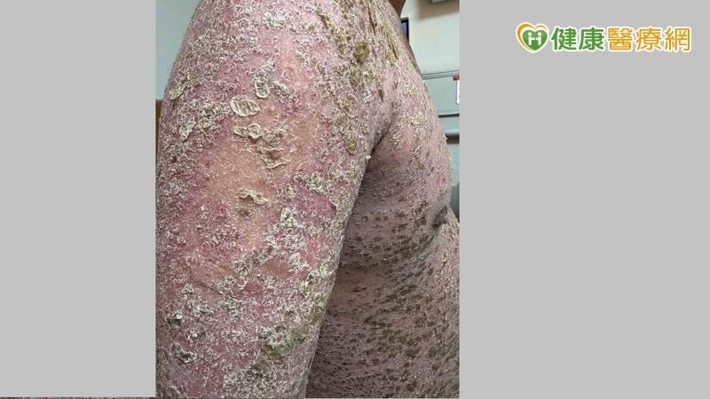 染新冠後全身爆膿疱！醫揭「罕見免疫反應」：與基因突變有關