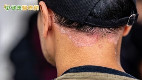 染新冠後全身爆膿疱！醫揭「罕見免疫反應」：與基因突變有關