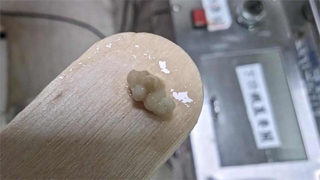  50%台人都中招！一張嘴「小米粒」超臭...醫示警「1壞習慣」養結石