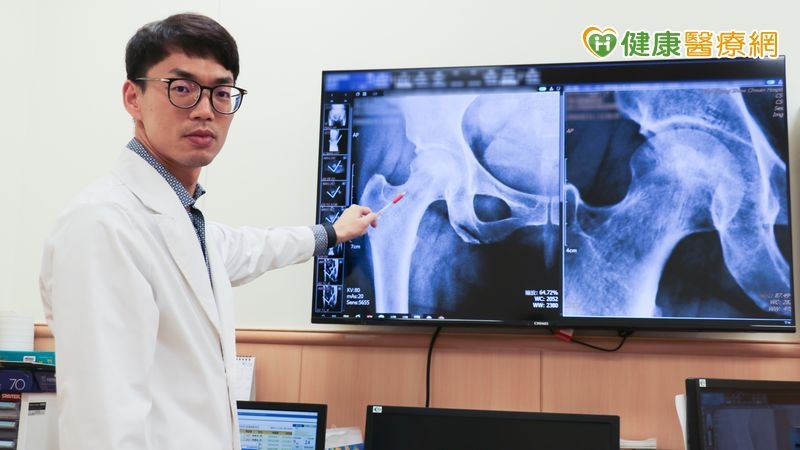 髖部疼痛半年竟是股骨頭壞死　醫：及早治療有助延後換關節