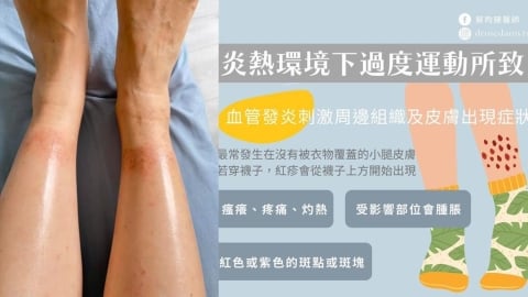 出國暴走腳踝起紅疹超癢?醫曝「迪士尼皮疹」高風險族群...教「6招」快速舒緩