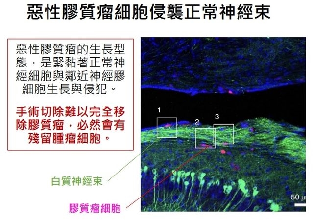 用超音波打開血腦屏障 長庚醫院「膠質母細胞瘤」研究成果登國際期刊
