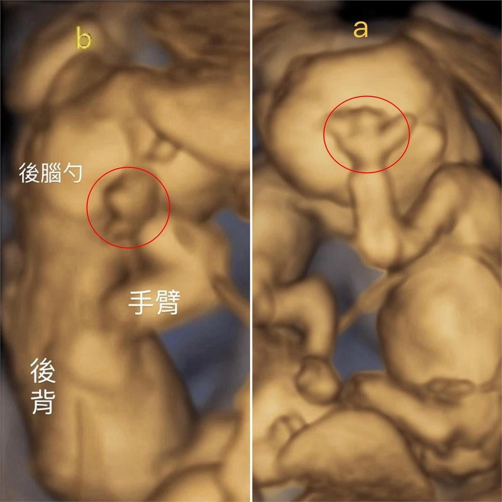 鄭家純懷胎16週爆身材「1變化」!曬超音波「雙寶做1姿勢」:在安慰我