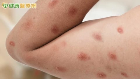 20多歲男染M痘!疾管署:台灣首見Ib型病毒株 小心5大皮膚症狀