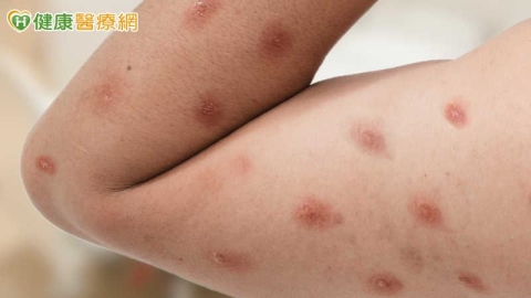 20多歲男染M痘!疾管署:台灣首見Ib型病毒株 小心5大皮膚症狀