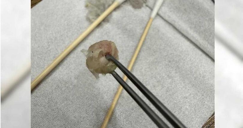 一名6歲女童因長期鼻塞就診,原本以為只是普通感冒,沒想到竟從鼻腔內夾出一大團已結塊的衛生紙。(圖/翻攝自臉書,郭子龍醫師)
