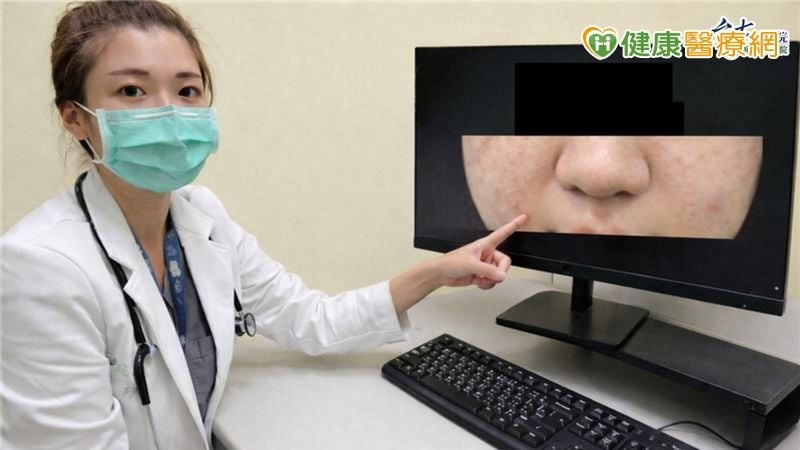 女童全身紅疹又臉腫「無呼吸困難」一檢竟是急性過敏