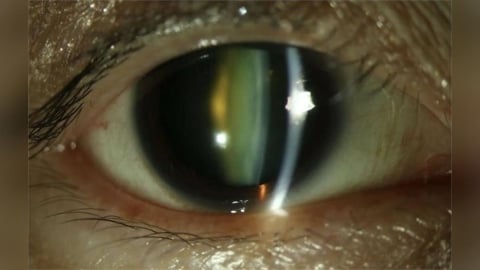連換多副眼鏡仍看不清? 眼冒「4大症狀」恐已白內障