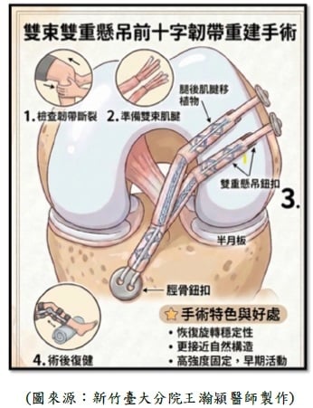 膝蓋「啪」一聲前十字韌帶斷裂!微創雙束重建治療助恢復跑跳