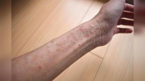 苗栗爆境外移入麻疹!外籍女泰國返台後確診 公共足跡曝光
