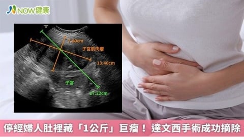 停經婦人肚裡藏「1公斤」巨瘤! 達文西手術成功摘除