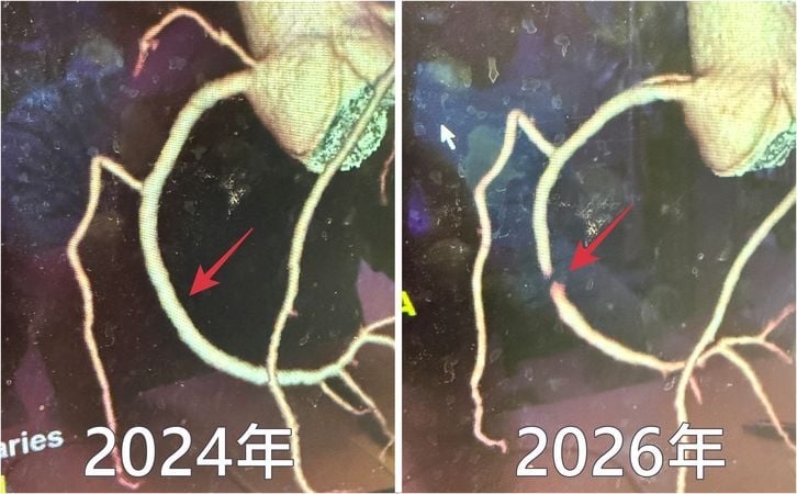 50歲男走快一點就胸悶、冒冷汗!一查冠狀動脈竟嚴重阻塞 醫揭常見警訊