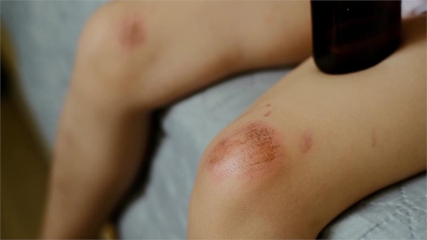 腳上傷口總是不會好?恐是下肢潰瘍!皮膚科醫揭「4大成因」、照護「關鍵」!