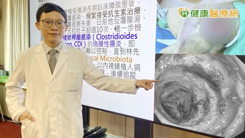 男子「困難梭狀桿菌感染」一天狂拉10多次!「糞菌移植」改善症狀