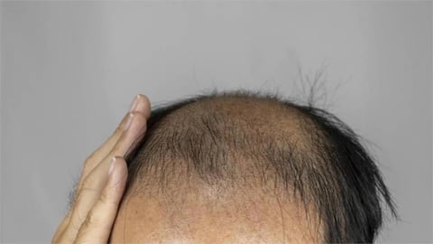 洗髮精「一罐用好幾年」恐禿頭?醫示警:至少1至3個月就要檢查!