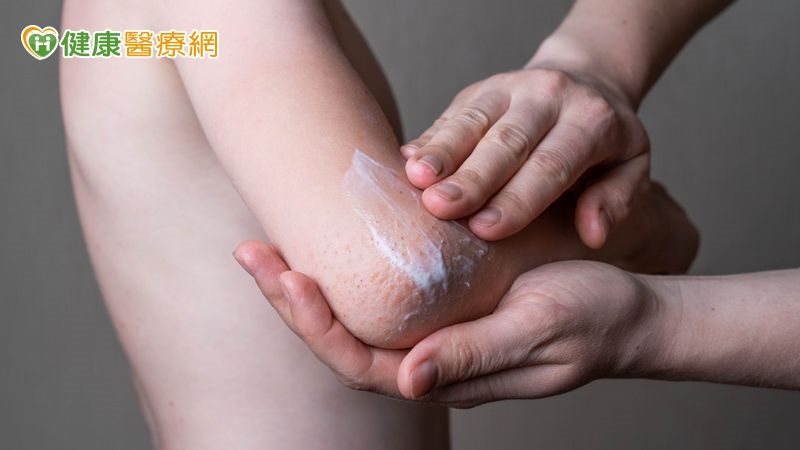 慢性發炎+搔癢難眠恐阻長高 異膚兒積極治療護膚又改善發育
