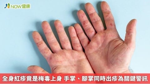 全身紅疹竟是梅毒上身 手掌、腳掌同時出疹為關鍵警訊