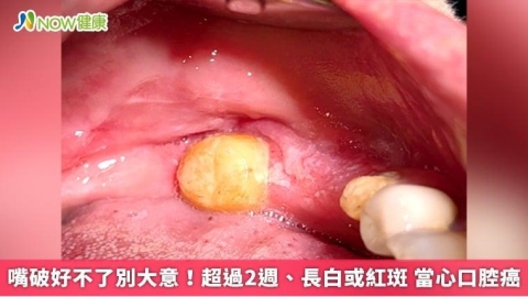 嘴破好不了別大意!超過2週、長白或紅斑 當心口腔癌