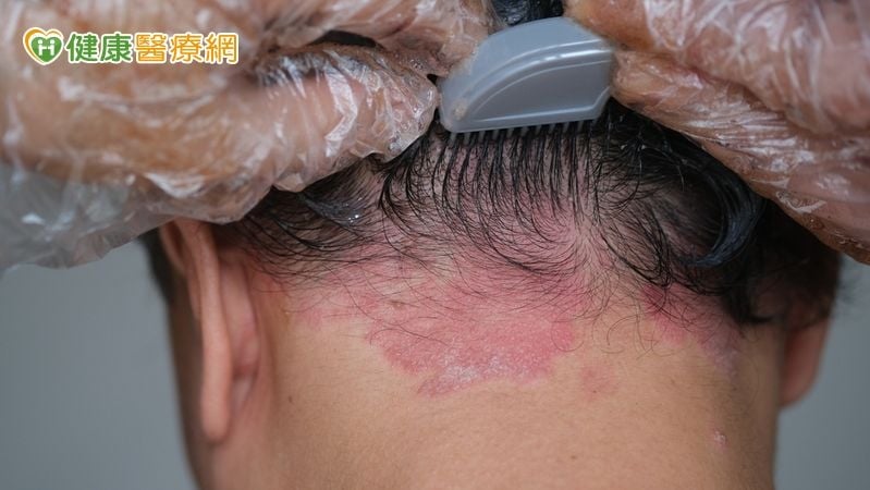 美甲、染髮好傷身？醫：多以「接觸性皮膚炎」過敏居多
