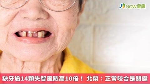 缺牙逾14顆失智風險高10倍！ 北榮：正常咬合是關鍵