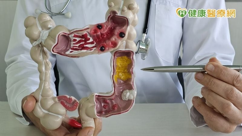 58歲男大腸息肉長成「一片厚草皮」微創治療免開腹除病灶
