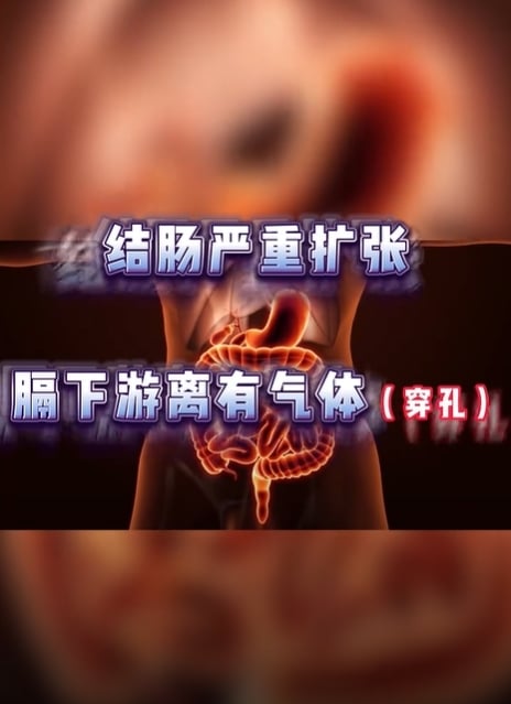 結腸穿孔險喪命!9歲童吃夜市「1食物」緊急進ICU 醫曝關鍵原因