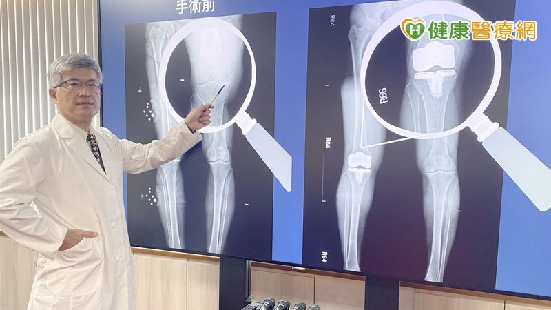 退化性膝關節炎痛到失眠?機械手臂置換精準定位助重拾行動力