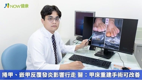 捲甲、嵌甲反覆發炎影響行走 醫:甲床重建手術可改善