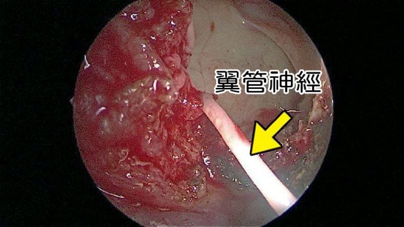 過敏性鼻炎吃藥開刀仍反覆發作　翼管神經阻斷術改善復發困擾