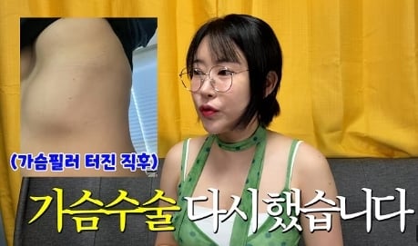 女星砸千萬隆乳慘變惡夢!填充物下垂到肋骨變「4個胸部」畫面首度公開