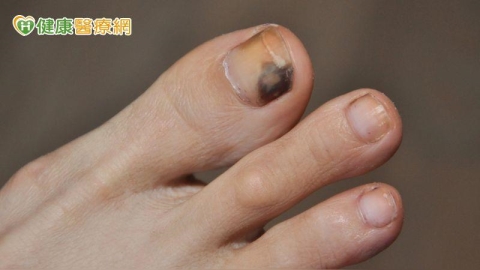 黑痣快速擴大恐是惡性黑色素瘤 醫揭免疫治療機轉與防護重點