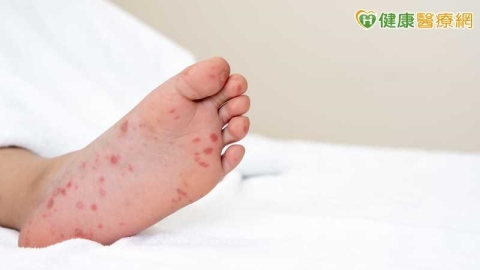 腸病毒疫情緩升增1重症!未滿5歲女童染D68型 8重症警訊須留意