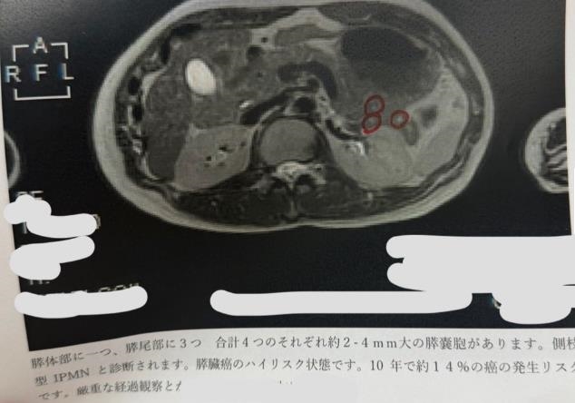 前女團成員「胰臟查出4顆腫瘤」崩潰!自曝「兩年前健檢全A」認1事:太放縱