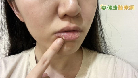 撕嘴皮撕到流血仍停不下來?醫揭可能與大腦1機制有關 當心是情緒警訊