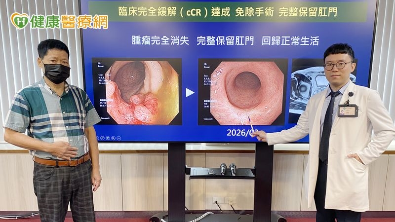 腸癌「TNT治療」保留肛門！適用癌友多