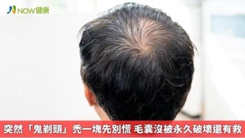 突然「鬼剃頭」禿一塊先別慌 毛囊沒被永久破壞還有救