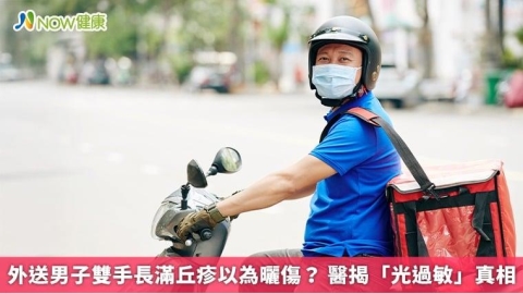 外送男子雙手長滿丘疹以為曬傷？ 醫揭「光過敏」真相