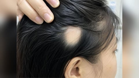 起床突見頭皮「硬幣大小髮掉光」   圓禿愛找兩類人