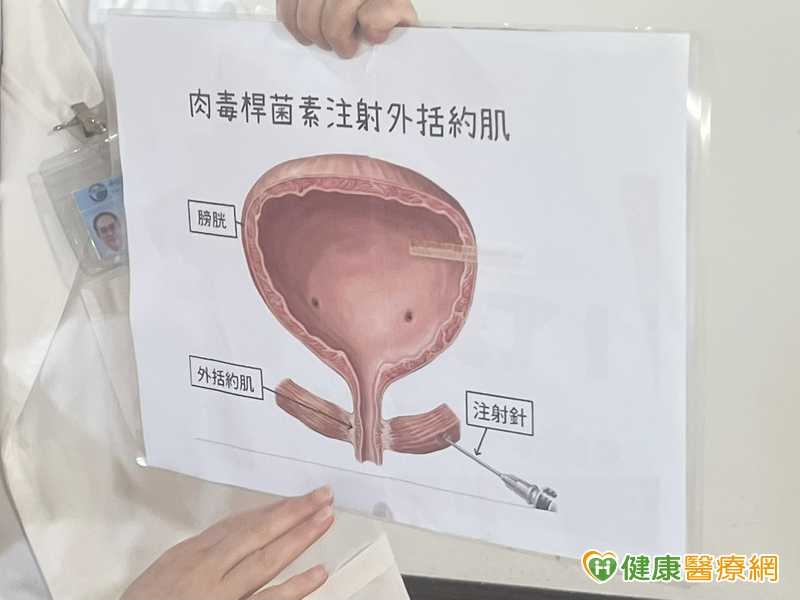 曾1天導尿5次！31歲女膀胱無力　肉毒素注射合併手術成治療選項
