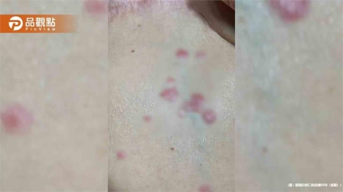 腹部突然有紅疹不痛不癢!竟是乳癌轉移 醫曝2大警訊別輕忽