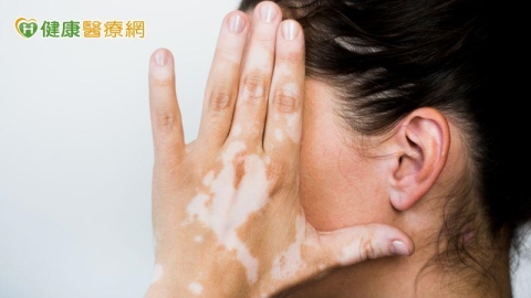 女大生臉部白斑引發人際焦慮 自體色素移植+微創治療還本來面目