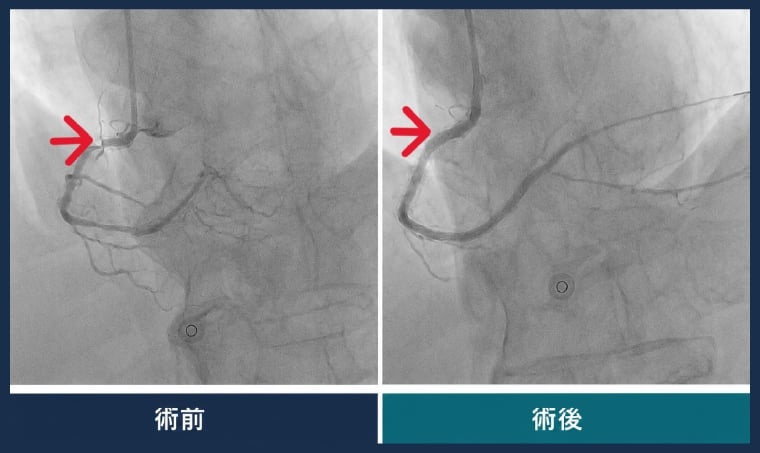 胸悶難呼吸竟是心導管阻塞 男子高血脂卻自行停藥惹禍