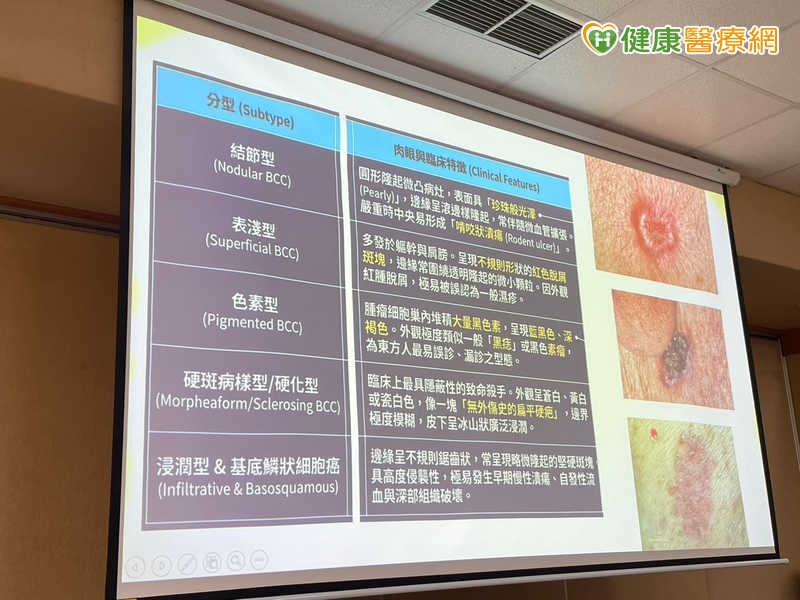 皮膚癌長在眼鼻口、腳底要當心 北榮「緩慢莫氏手術」拚留健康組織