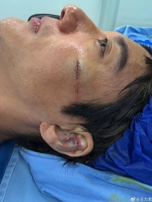 王力宏中國開唱「耳骨撞碎」驚悚畫面曝!證實「重摔縫39針」文末預告1事