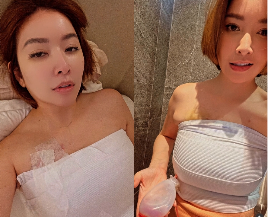 許維恩PO片「切除雙乳」抗乳癌過程!突喊「7月又要衝一波」網湧入關心