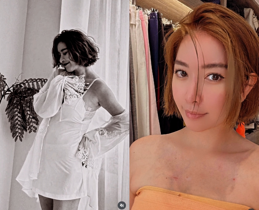 許維恩PO片「切除雙乳」抗乳癌過程!突喊「7月又要衝一波」網湧入關心