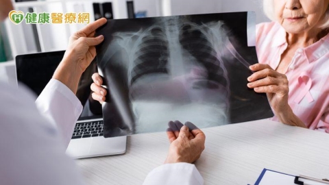 破解肺癌偽裝身份!靠免疫四藥聯合有望取得長期存活效益