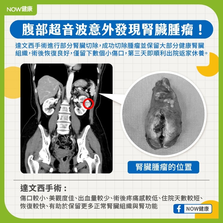 健檢驚見左腎藏腫瘤 婦人靠「達文西微創」保住腎功能
