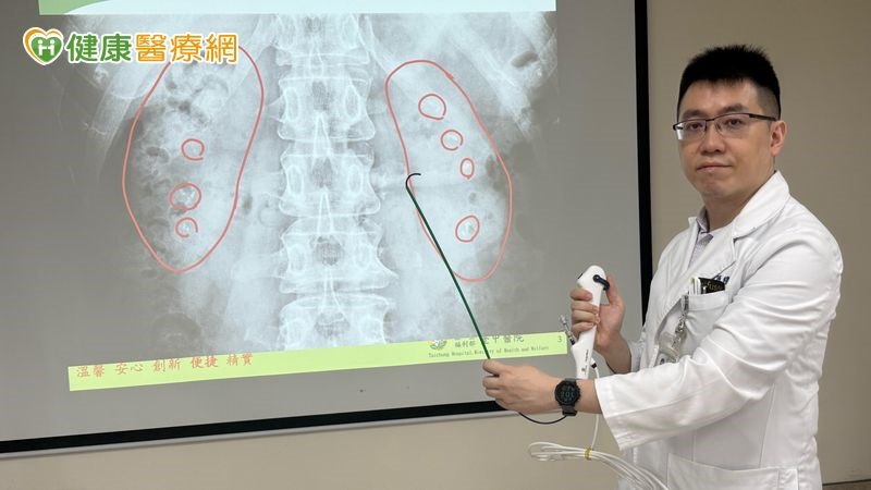 半年腎結石3次!50歲婦雙腎如「葡萄乾麵包」醫曝反覆發作原因