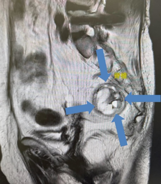 婦肛門劇痛半年只能臥床!驚見直腸後「罕見腫瘤」 醫曝:恐與遺傳肥胖相關